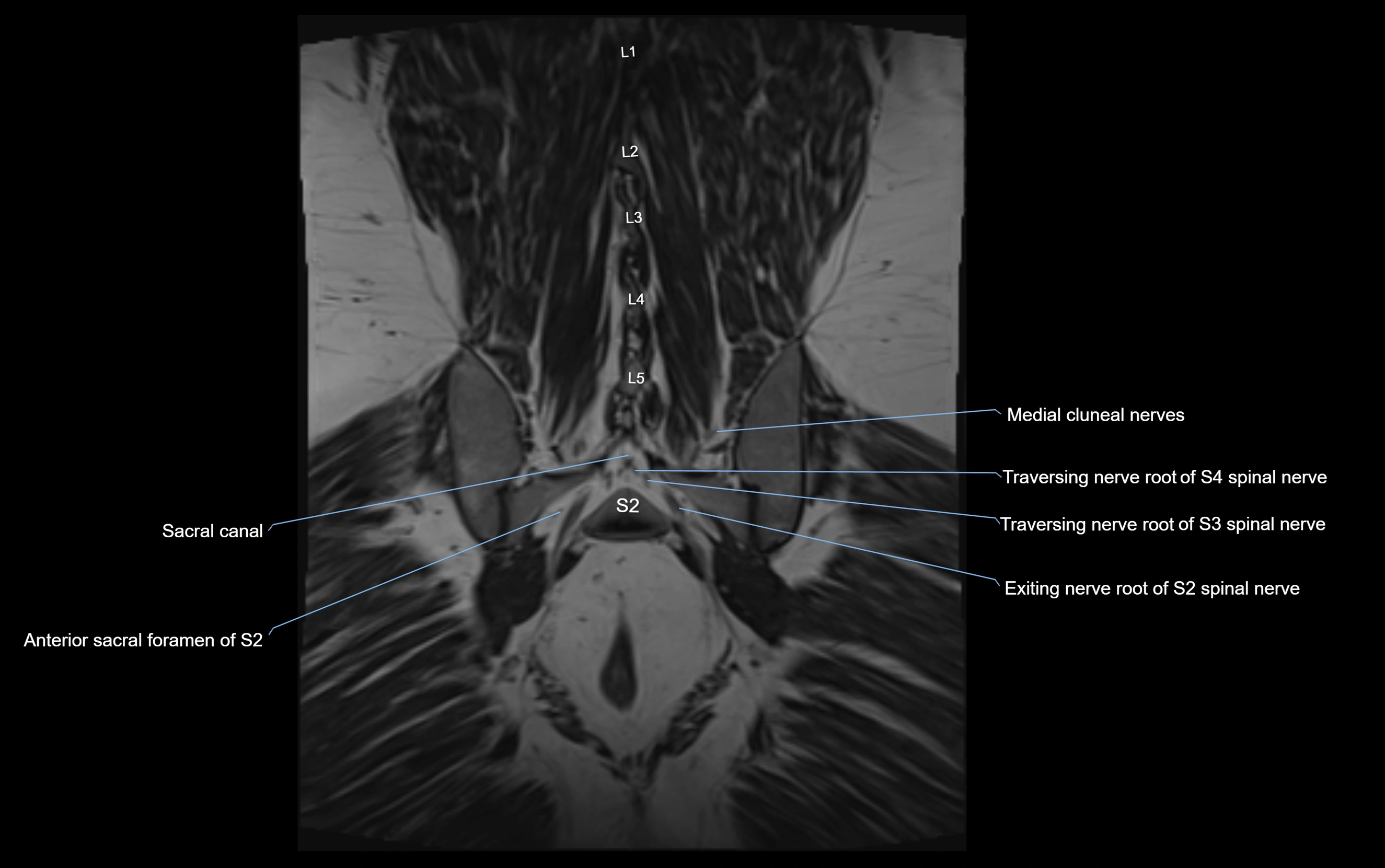 MR lumbosacral plexus cross sectional anatomy 3T  radiology  image-img-09001-00064.webp